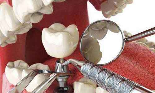 上海牙齿治疗术后注意哪些问题!