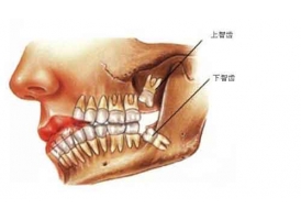智齿为什么会“横着”长?上海做矫正拔智齿有什么好处?