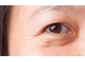 上海怎么去眼角纹,术后如何护理呢?