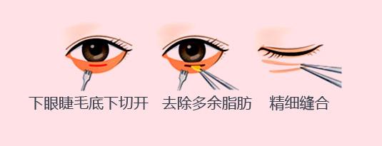 上海美莱整形，臃肿眼袋应该要怎么除去呢