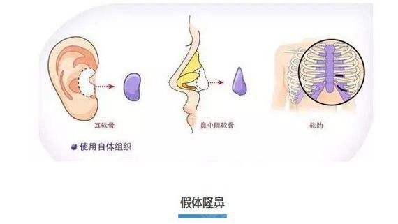 上海医院假体做硅胶隆鼻会钙化吗