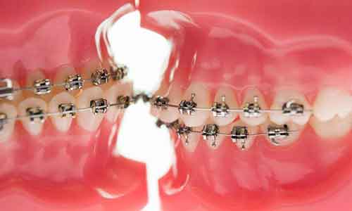 龅牙矫正牙齿疼吗,上海医院是怎么矫正的!