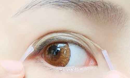 双眼皮失败了的原因!上海双眼皮失败有什么危害吗?