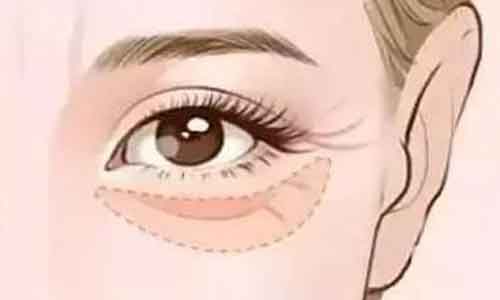 去除眼袋手术方法:美莱4D光触无创祛眼袋!