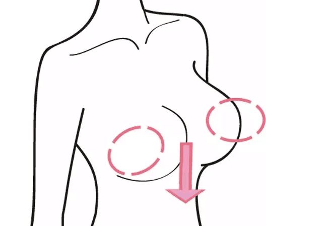 上海怎样去除并改善乳房下垂的症状？