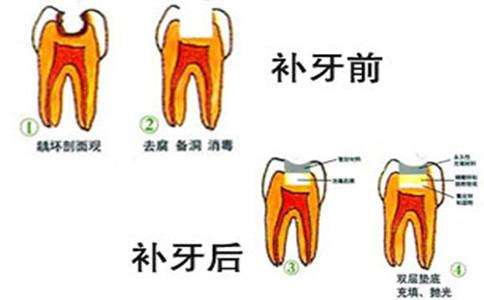 上海做补牙一般多少钱一颗