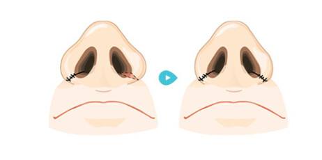 美莱整形鼻部，鼻翼缩小手术会不会影响呼吸