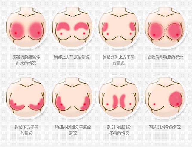 吸脂自体脂肪做隆胸手术上海好的医院是哪家
