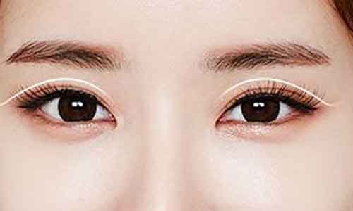 上海割双眼皮方法有哪些*适合什么类型的人做?