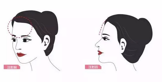 上海美莱医疗美容告诉您额头饱满女人更好命
