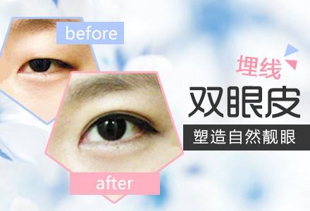 上海长宁区美容院做了埋线双眼皮能保持多久