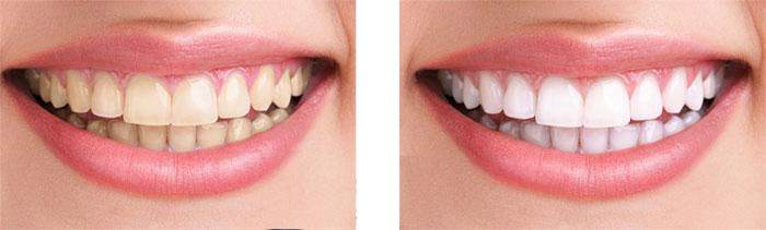 美莱科普丨为什么矫正牙齿需要两年时间呢？