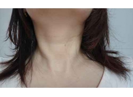 怎么去除脖子上的颈纹?上海激光、注射玻尿酸可以去除!