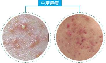 上海美莱“激光祛痘”，你的肌肤橡皮擦