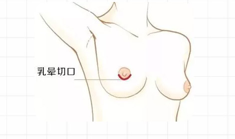 上海做隆胸怕留疤？更隐蔽的隆胸切口在这里！