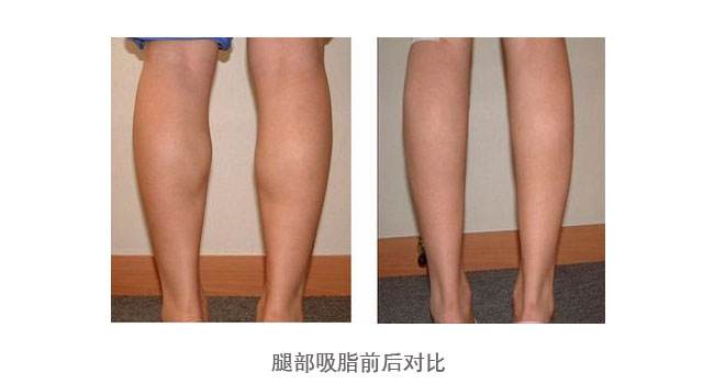 上海美莱吸脂瘦腿的方法可靠吗?