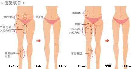 上海做一个大腿抽脂有什么效果?何不选择美莱抽大腿？