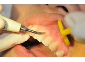 美莱科普“洗牙后会导致牙缝变大吗”，那是不可能！