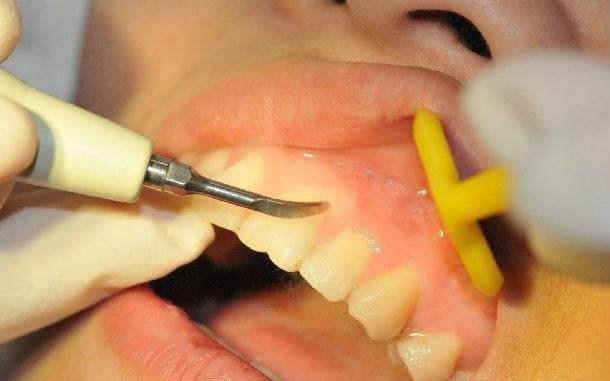 美莱科普“洗牙后会导致牙缝变大吗”，那是不可能！