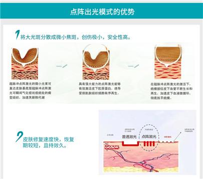 上海祛痘医院，做一个点阵激光祛痘多少钱？