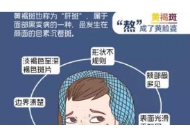 女性黄褐斑的治疗办法,上海医院有吗?