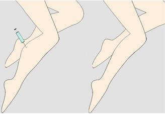 在美莱注射了瘦腿的效果可以保持多久？
