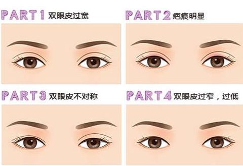 上海哪家双眼皮做的好？美莱割双眼皮怎么样？