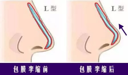 上海做隆鼻会变形吗?术后几年会发生变形情况?