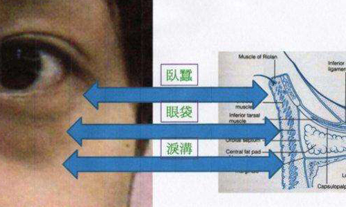 上海自体脂肪和注射玻尿酸填充泪沟,两个哪个更好?