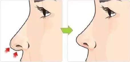 美莱假体隆鼻和综合隆鼻有什么不同?哪种更好?