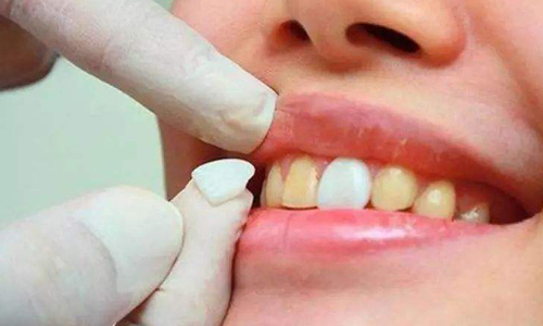 上海牙齿贴面能保持多久?有没有什么副作用呢?