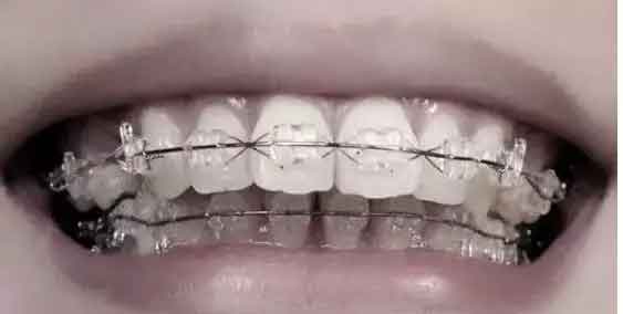 上海瓷贴面可以修复牙齿染色、牙齿受损、过小牙、牙缝过大的问题!