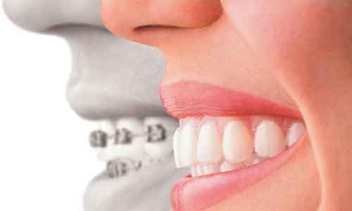 上海烤瓷牙VS牙齿治疗方式不同,会有哪些不一样?