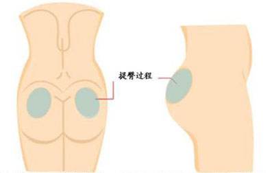 上海臀部抽脂减肥，美莱怎样很快减掉臀部过剩脂肪