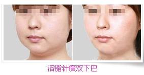 上海做吸脂医院，用激光吸脂瘦脸花多少钱？