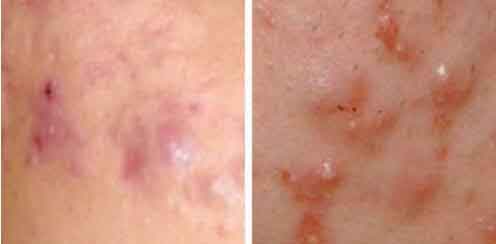 美莱化学酸嫩肤祛痘印，美化你的肌肤!