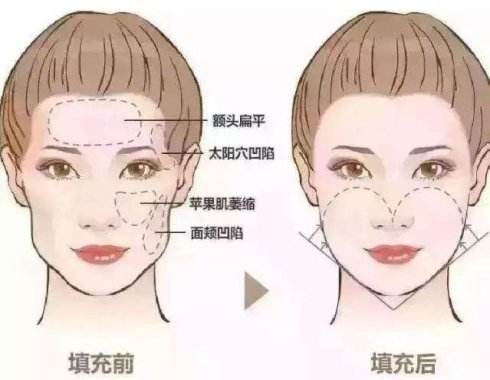 上海做注射玻尿酸全脸填充的价格是多少钱？