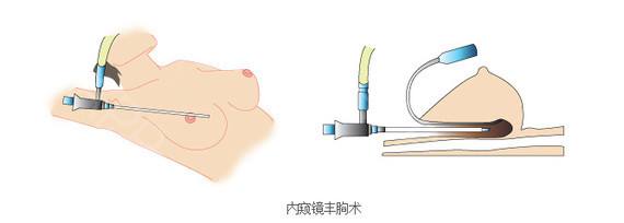 上海做丰胸，隆胸术前设计有哪些事项？