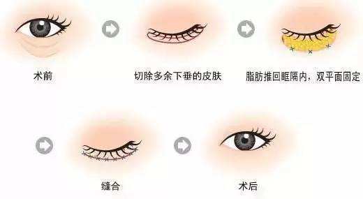 美莱吴海龙普及：上海眼部整形，激光去眼袋哪里效果好