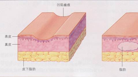 美莱脂肪移植填充，美莱告诉我们脂肪填充可能存在危害有哪些？