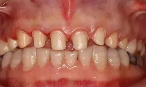美莱医生告诉你:什么样的牙齿需要矫正!