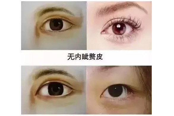上海美莱|纠结了三年，双眼皮怎么做才好看？