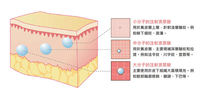 上海注射微创申涛科普|玻尿酸的作用与实际功效