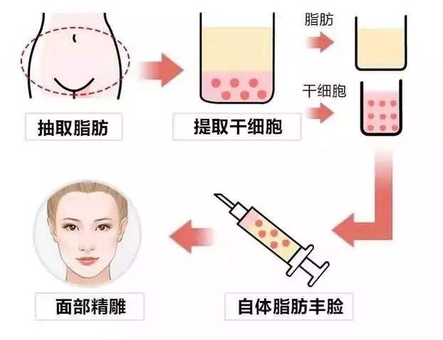上海美莱申涛：自体脂肪填充和玻尿酸填充的对比