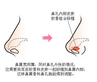 上海美莱鼻小柱整形手术如何？