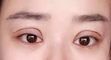 上海双眼皮手术需要多少钱？