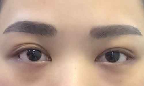 上海修复双眼皮风险大吗?