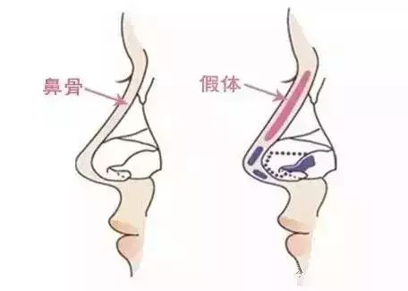 美莱陈斌讲解：隆鼻假体能保持多久