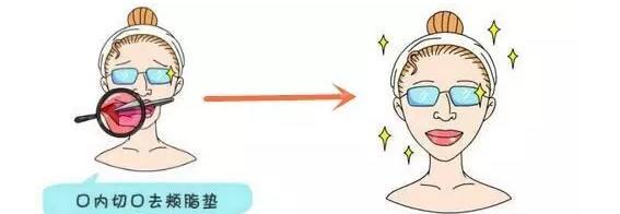 上海做祛颊脂垫瘦脸能让脸凹陷吗？