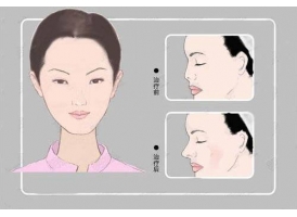 上海注射美容医院，鼻部整形注射隆鼻哪家好?